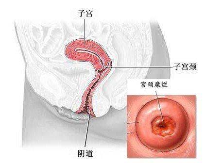 妇科疾病宫颈糜烂